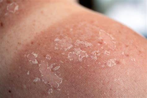 Things Dermatologists Need You To Know About Skin Cancer Readers Digest