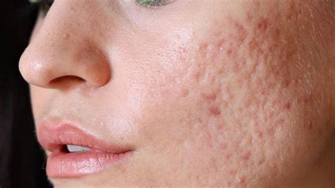 Acne Scars Treatment Near South Delhi Sarin Skin Solutions Sarinskin