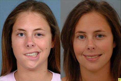 Facial Paraylsis Reconstructive Florida Sex Photo