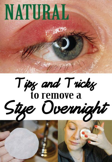 How To Remove A Stye From Your Eyelid