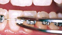 C Mo Arreglar Los Brackets En Casa Smile Logic Orthodontics South