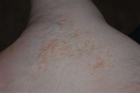 I Have A Rash On My Ankles And A Bit On My Feet Ive Had