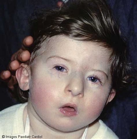 Clinical utility gene card for: Síndrome de Prader-Willi
