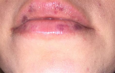 Dark Spots On Lips After Fillers