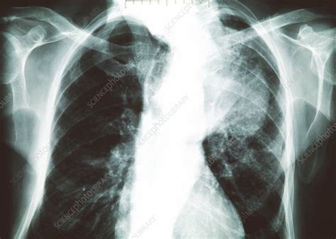 X Ray Of Lung Cancer Stock Image M1340358 Science Photo Library