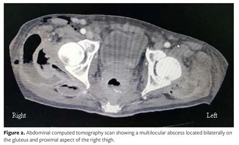 Thigh Abscess Secondary To Intra Abdominal Pathologic Conditions