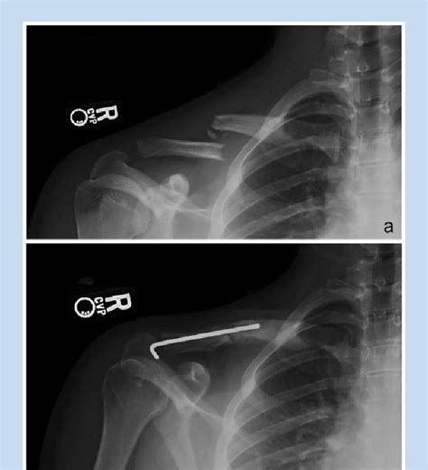Middle Third Diaphyseal Clavicle Fracture Malunion In A 10 Year Old