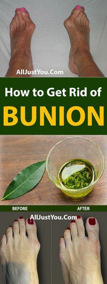 Learning how to prevent bunions can go a long way toward improving the quality of life and maintaining mobility. Get Rid of Bunions Naturally With This Simple But Powerful ...