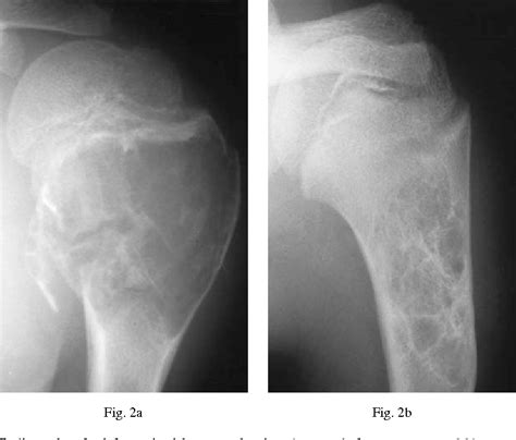 Figure 2 From Unicameral Bone Cysts Treated By Injection Of Bone Marrow