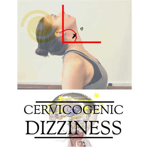 Cervico Ocular Reflex Cor In Cervicogenic Dizziness Cervicogenic