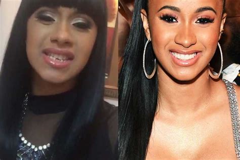 Cardi B Teeth Before And After Cost Surgery Pictures