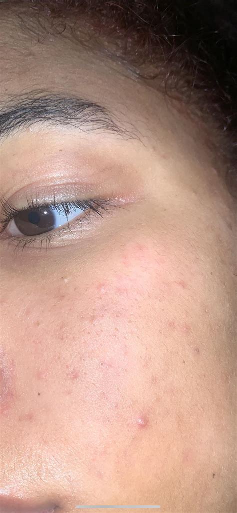 Skin Concern How Can I Get Rid Of These Little Red Spots And Bumps On