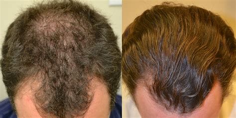 With this kind of hair loss, you may end up with bald spots if you are a man. Propecia before and after photos - Dr Rogers - New Orleans