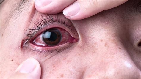 Ask The Expert Dr Gabriel Sosne Pink Eye And Viral Eye Infections