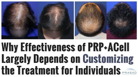 How Effectiveness Of Prpacell Hair Loss Treatment Depends On Customization For Individuals