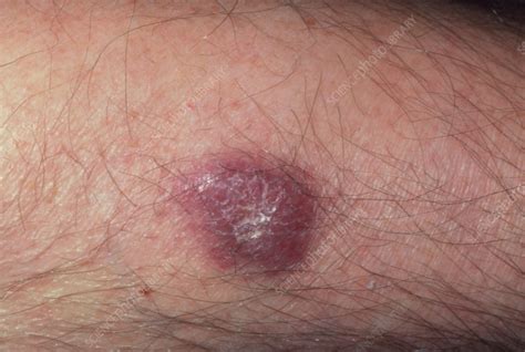 Kaposis Sarcoma Lesion On Leg Of An Aids Patient Stock Image M112