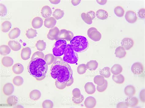 Leukemia Cells Stock Photo Download Image Now Lymphoma Chronic