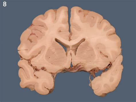 Coronal Brain Slices Diagram Quizlet