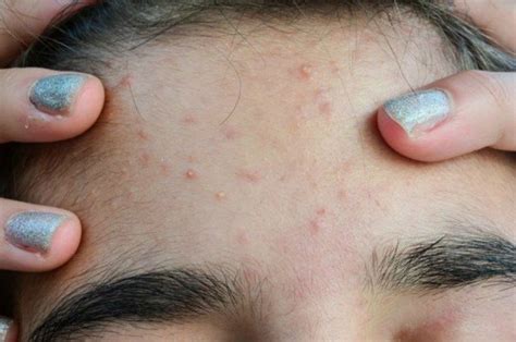 Preteen Acne All That You Need To Know About The Causes Treatment And