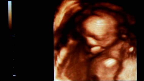 Baby Ultrasound Video Stock Footage Video 3524294
