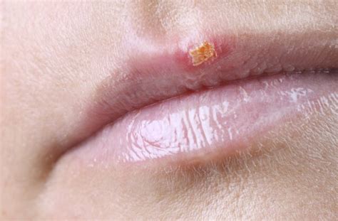 How To Prevent And Treat Cold Sores Wellness Us News