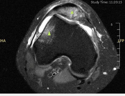 Axial T2 Weighted Mri Of The Right Knee Showing The Classical Bone