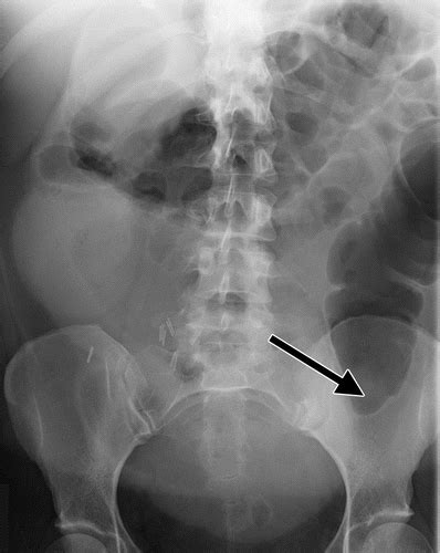 A ct scan can often detect evidence of a growth or tumor. Colon Cancer Abdominal X Ray - Plain Abdominal X Ray : It ...