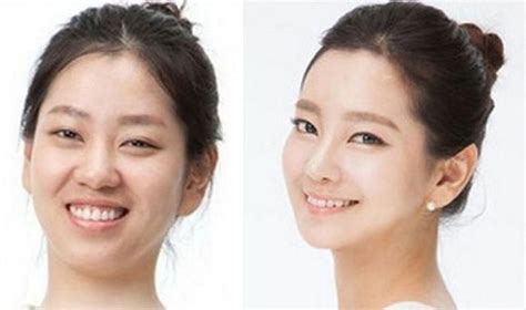 Korean Face Plastic Surgery Chin And Nose Before And After