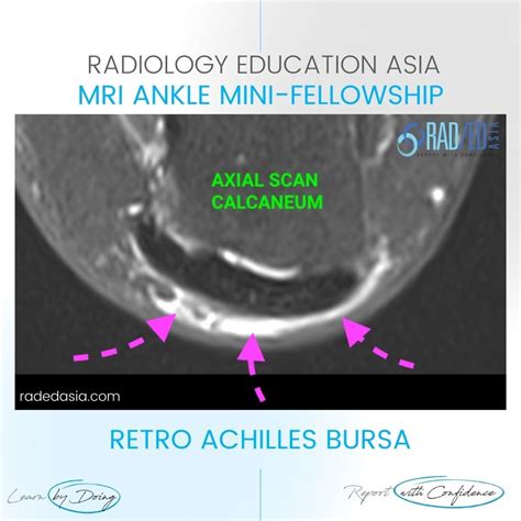 Retroachilles Bursa Bursitis Mri Radiology Ankle Radedasia