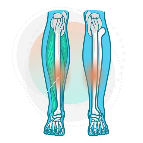 Medial Tibial Stress Syndrome How To Fix Shin Splints