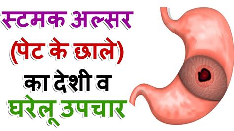 Home Remedy For Stomach Ulcer In Hindi Homemade Ftempo