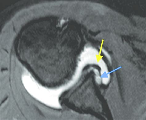Paralabral Cyst On Axial Fat Saturated T1 Weighted Mr Arthrographic