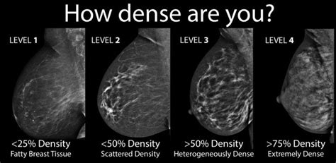 What Does It Mean To Have Dense Breasts Womens Imaging