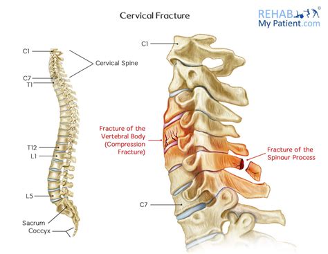 Cervical Fracture Human Spine Vertebrae Damage Outline Diagram Labeled Educational Stock