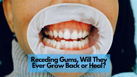 Receding Gums Will They Ever Grow Back Or Heal Sheehan Dental