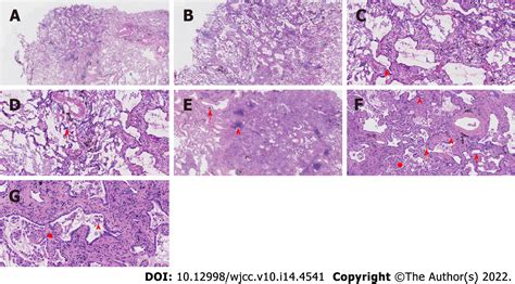 Bronchiolar Adenoma With Unusual Presentation Two Case Reports