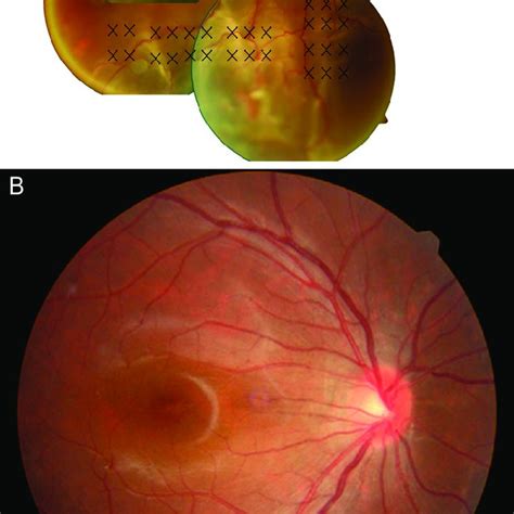 Pdf Clinical Characteristics Of Rhegmatogenous Retinal Detachment