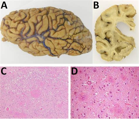 Macroscopic Examination Of The Brain Showing A Cortical Brain Atrophy