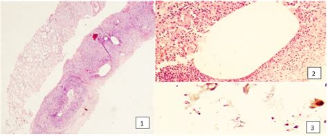 Figure 1 Trucut Biopsy Of Breast Tissue Showing Cystic Like Spaces