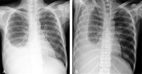 Opacification of entire hemithorax and shifting of mediastinum to the opposite side. Chest X-ray. (A) Chest PA, (B) Chest right decubitus vi ...