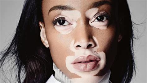 Vitiligo Skin Disease All You Should Know About The Skin Disorder