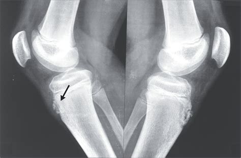 Osgoodschlatter Disease Nejm