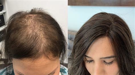 Three Stage Cancer Hair Loss Process Chuck Alfieri