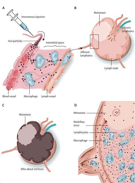 Mri With A Lymph Node Specific Contrast Agent As An Alternative To Ct