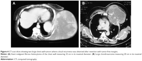 Massive Chest Wall Resection And Reconstruction For Malignant Disease Ott