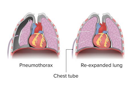 Pneumothorax Concise Medical Knowledge
