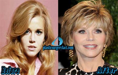 Jane Fonda Plastic Surgery Before and After Photos ...