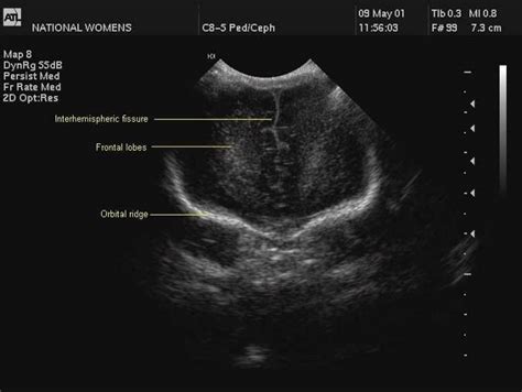 Cranial Ultrasound A Guideline For The Performance Of Routine Cranial