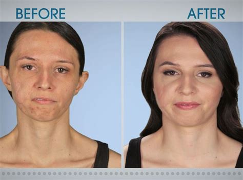 Cheeky But Not Smiling From Botched Patients Before And After