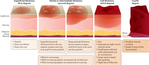 Most burns are due to heat from hot liquids, solids, or fire. Burn injury | Nature Reviews Disease Primers